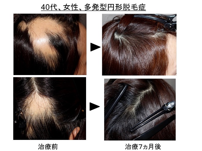 円形脱毛症　病院